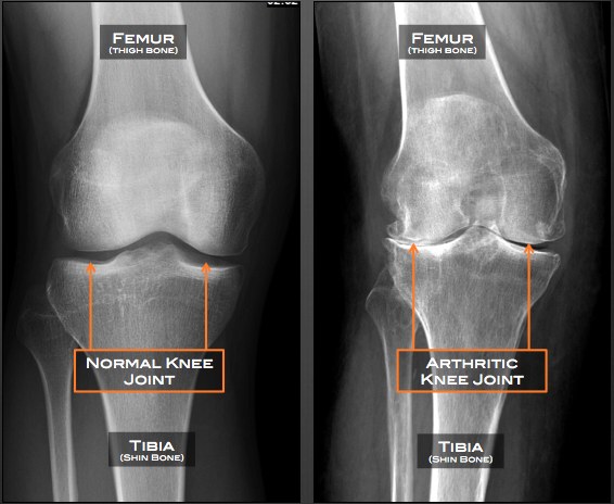 Labelled X-rays comparing a normal knee joint and an arthritic knee joint with reduced joint space